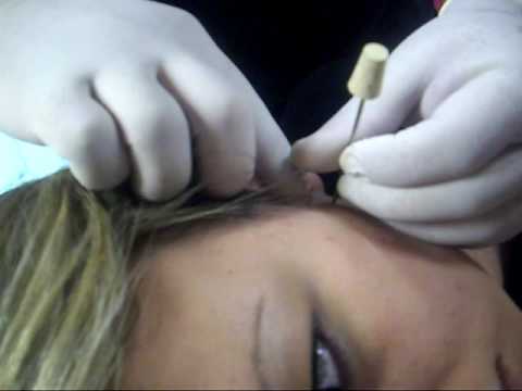 2nd time Vertical Tragus SURFACE Piercing
