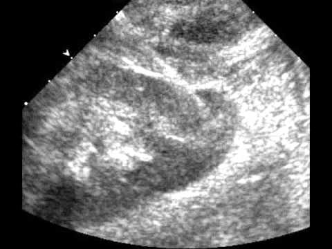 how to do a renal transplant ultrasound