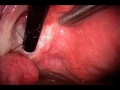 Endometriosis / Adhesions / Argon Beam Coagulation