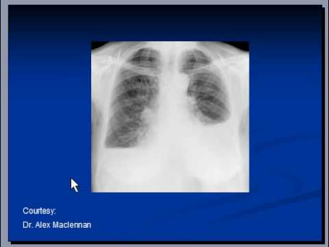 how to measure cardiomegaly on cxr