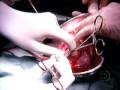 Imagens de um transplante de coração