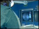 Medicina / Investigación: Un procedimiento pionero mediante braquiterapia evita que la vena cava vuelva a ocluirse