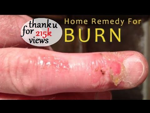 how to treat burn skin by oil