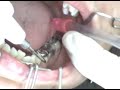 Remoção de coroa com ultra som Remoção de coroa com ultra som
