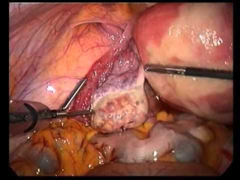 belly distension