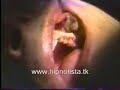 HIPNOTISTA CIRUGIA SIN ANESTESIA SURGERY HIPNOTISTA CIRUGIA SIN ANESTESIA SURGERY