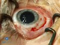 Scleral Buckling: Slinging Muscles & Marking Breaks