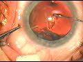 direct puncture capsulorhexis direct puncture capsulorhexis