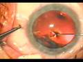 direct puncture capsulorhexis