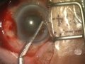 IFIS, cataract surgery 白内障手術(1)