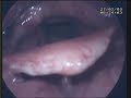 Stroboscopy pre and post laser surgery of Larynx for Leukoplakia