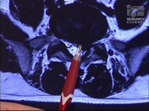 how to repair herniated disc