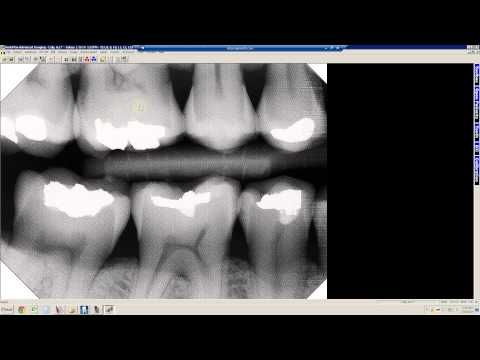 how to take x-ray pictures with camera