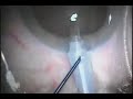 Efficient Cataract Surgery