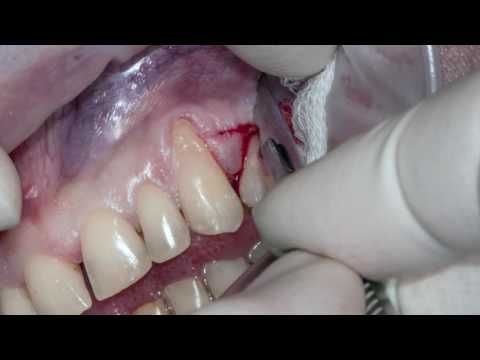 Практикум по пластике мягких тканей десны в области зубов и имплантатов. Часть 18