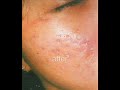acne scar treatment in the Philippines and Asia.wmv