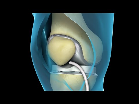 how to transplant knee