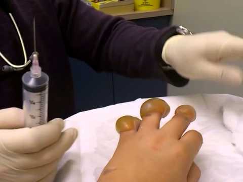how to cure frostbite