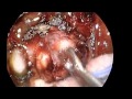 Endoscopic Removal of Pituitary Apoplexy Endoscopic Removal of Pituitary Apoplexy