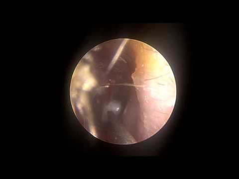 how to drain otitis media
