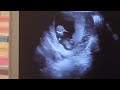 Pregnant with baby - 11 weeks 1 day ultrasound