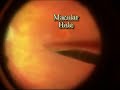 Macular Hole Old with ICG Stain Macular Hole