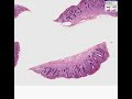 Histopathology Small intestine--Celiac sprue