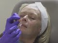 Video Botox injectables, before and after!