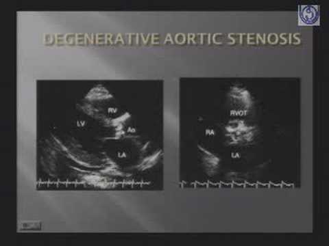 Valvular Heart Disease Aortic Stenosis