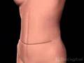 Breast Reconstruction 3D animation
