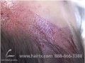 FEMALE HAIR TRANSPLANT: FEMALE HAIRLINE LOWERING DALLAS TX FEMALE HAIR TRANSPLANT: FEMALE HAIRLINE LOWERING DALLAS TX