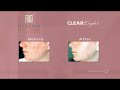 informational video on this cosmetic procedure presented by peter helton, d.o. of the helton skin and laser institute.

p. acnes bacteria produces endogenous porphyrins which absorbs blue-violet light. the treatment delivers high intensity blue-violet light to the porphyrins causing them to release peroxide. the natural chemical reaction destroys the bacteria with no effect on the surrounding tissue.

produced by patiently waiting tv in association with spore media