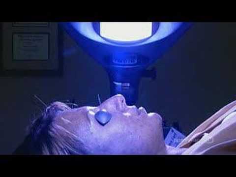 how to treat p acne