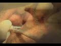 imtec-mini-implant-surgery-6-maxillary-implants.html