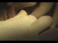 Imtec Mini Implant Surgery - 6 Maxillary Implants