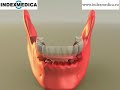 Implants full arch reconstruction on 4 implants locators Implants full arch reconstruction on 4 implants locators