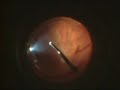 Vitrectomy for Vitreous Opacities (Floaters)
