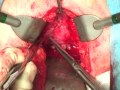 Radical Prostatectomy - Perineal Access