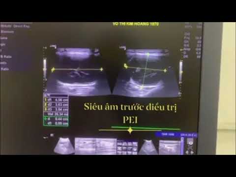 Hình thái tổn thương và mức đáp ứng sau điều trị tiêm cồn của cô giáo 50 tuổi