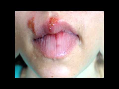 how to relieve herpes