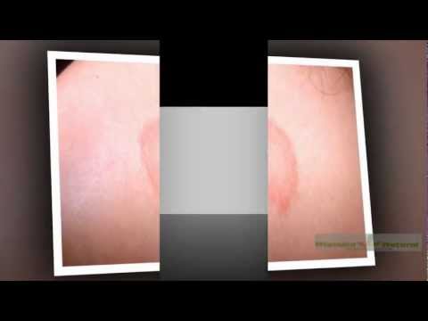 how to treat ringworm in cats nz