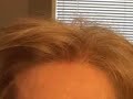 Hair transplant closeup:  female hairline