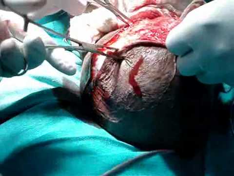 how to cure hydrocele