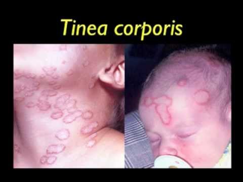 how to collect skin scraping