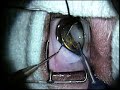 Canine cataract surgery with a lens implant in a dog Canine cataract surgery with a lens implant in a dog