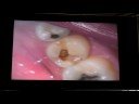 filling 2parts