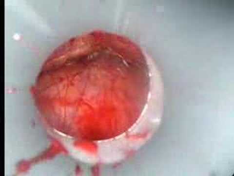 My Right Inguinal Hernia Surgery - ...