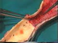 Aortic wall structural strengthening by net prosthesis Aortic wall structural strengthening by net prosthesis
