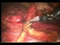 Robotic Living Donor Nephrectomy