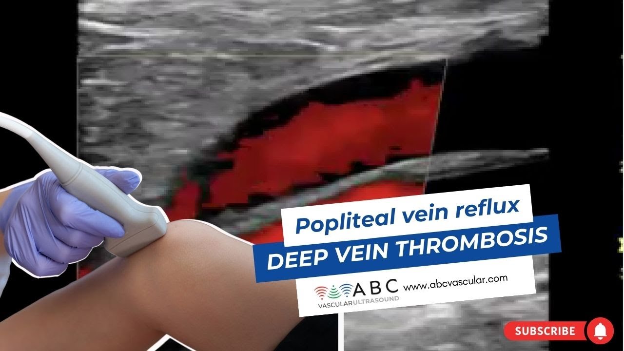 Popliteal vein reflux after deep vein thrombosis | Ultrasound